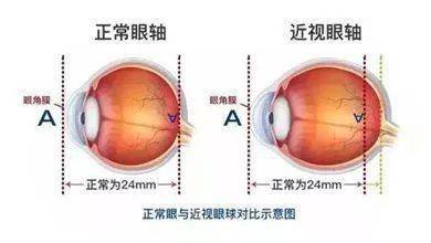 从眼轴增长的原理来说:眼睛的晶状体,睫状肌具有调节能力,如果长时间