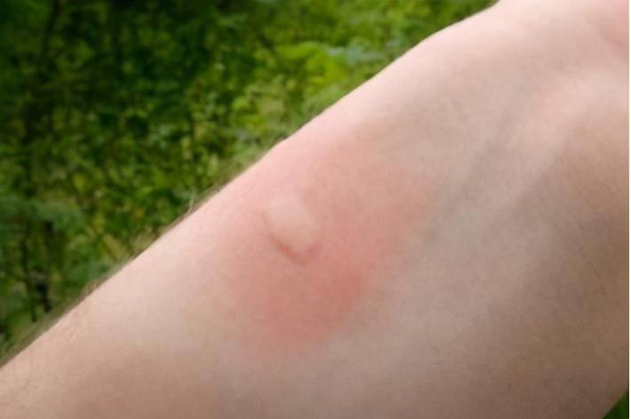 被蚊子叮咬后,皮肤上会出现一个 圆形且蓬松的隆起物,也就是我们常说