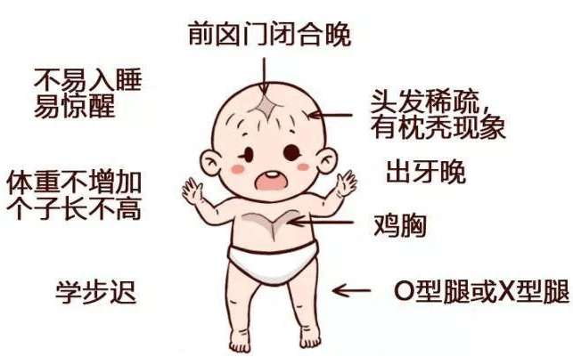 "鸡胸",小儿开始站立行走后会出现x型腿,o型腿等病变