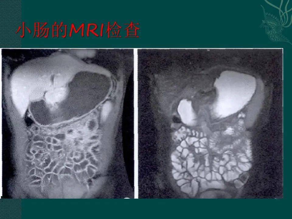 小肠疾病的影像学诊断