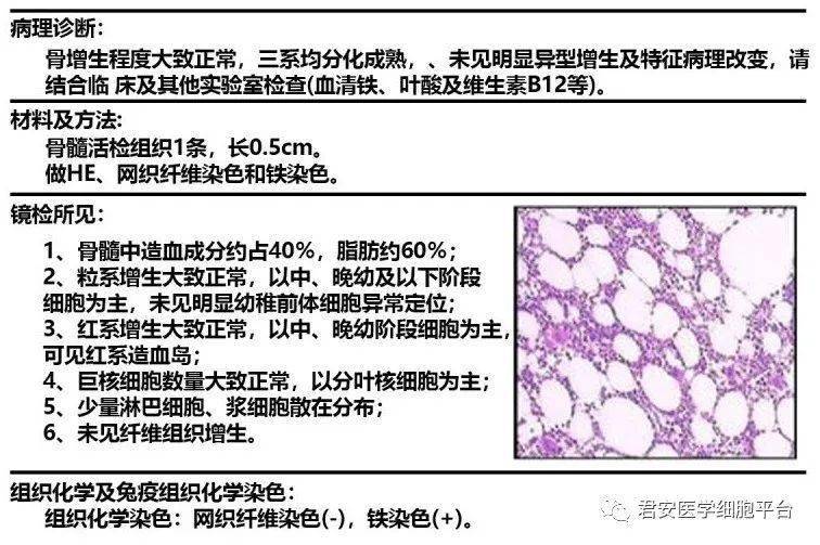 b 细胞淋巴瘤骨髓侵犯