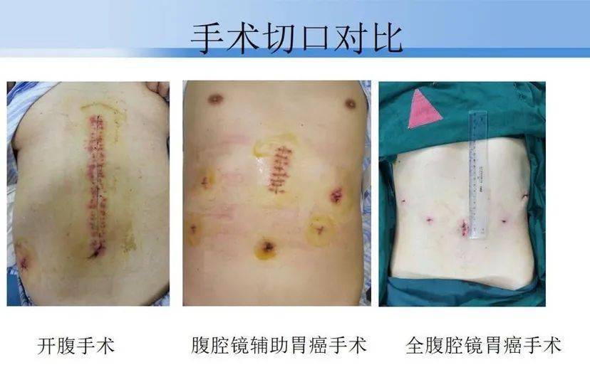 德清县人民医院普外科成功开展完全腹腔镜胃癌根治术