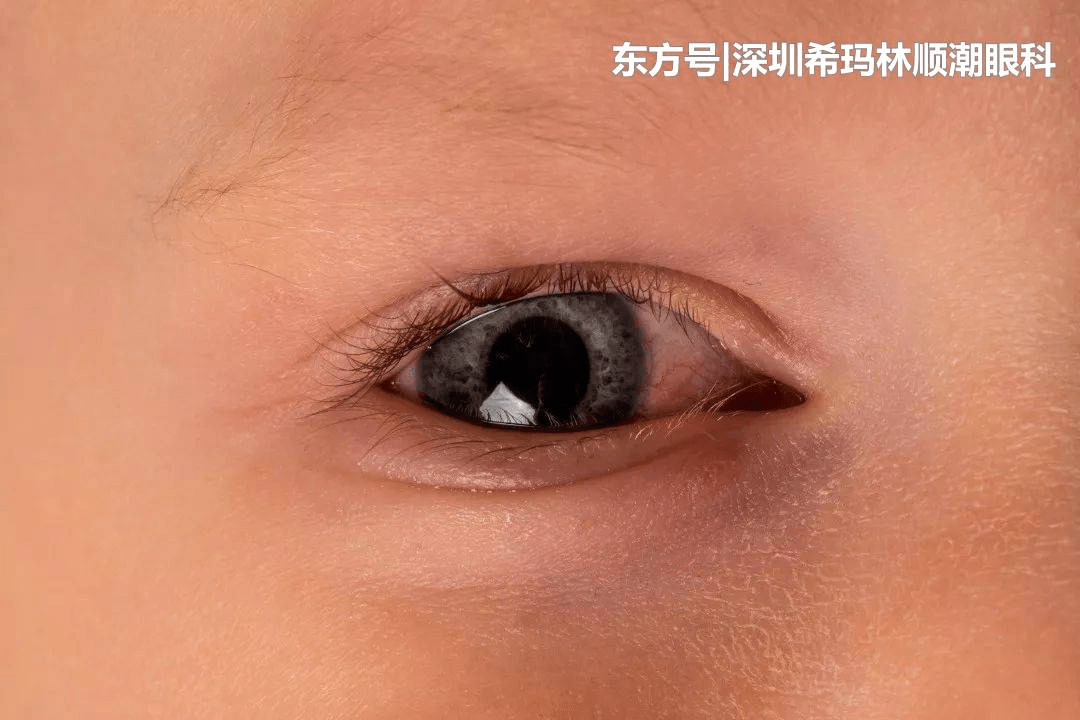 家长如何识别儿童常见眼病和视力异常