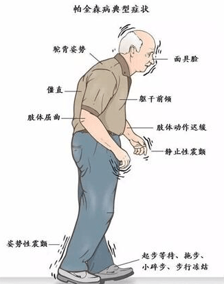 帕金森病的药物治疗_患者