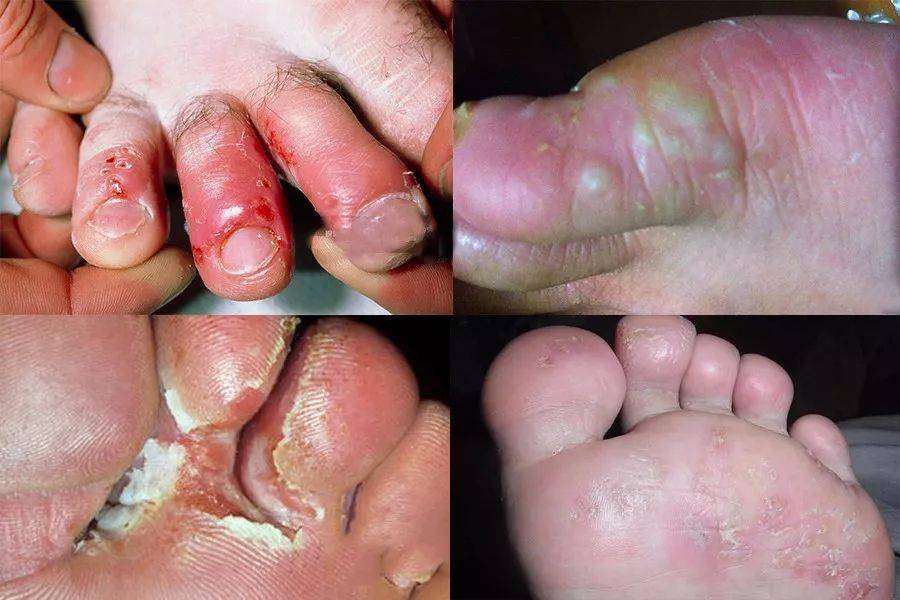 脚气瞬间复发  脚汗闷着不止发臭,更导致足部炎症  通常伴随着密密