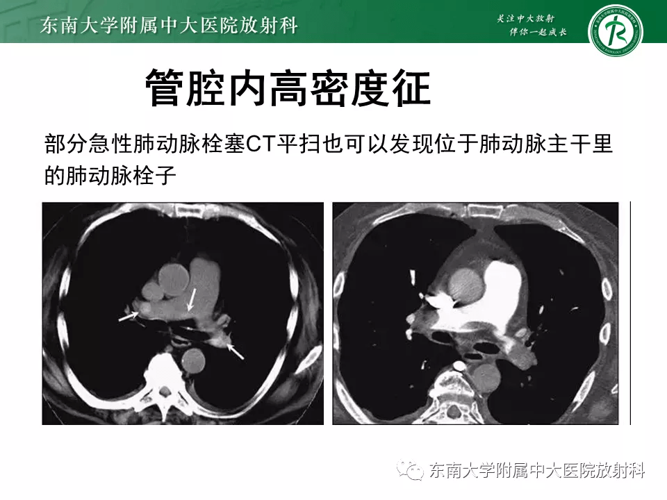 肺动脉栓塞的影像诊断