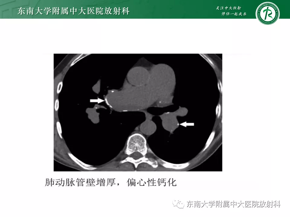 肺动脉栓塞的影像诊断