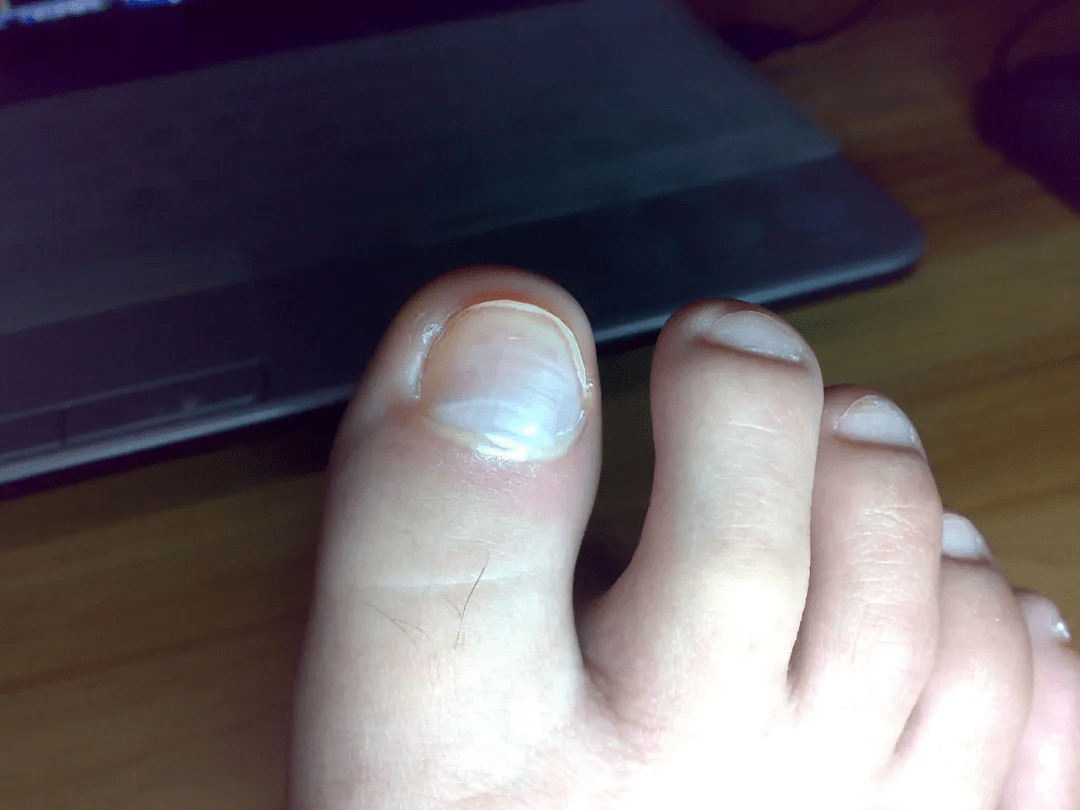 尤其是当一个人气血缺损的时候,脚指甲的颜色