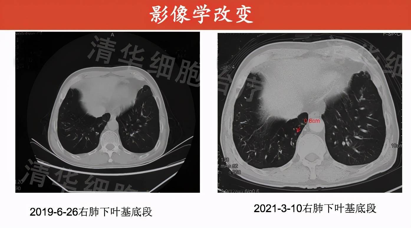 影像表现:右肺下叶基底段新发微小结节,注意观察随访.