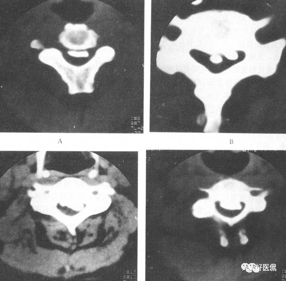 颈椎病解剖经典影像