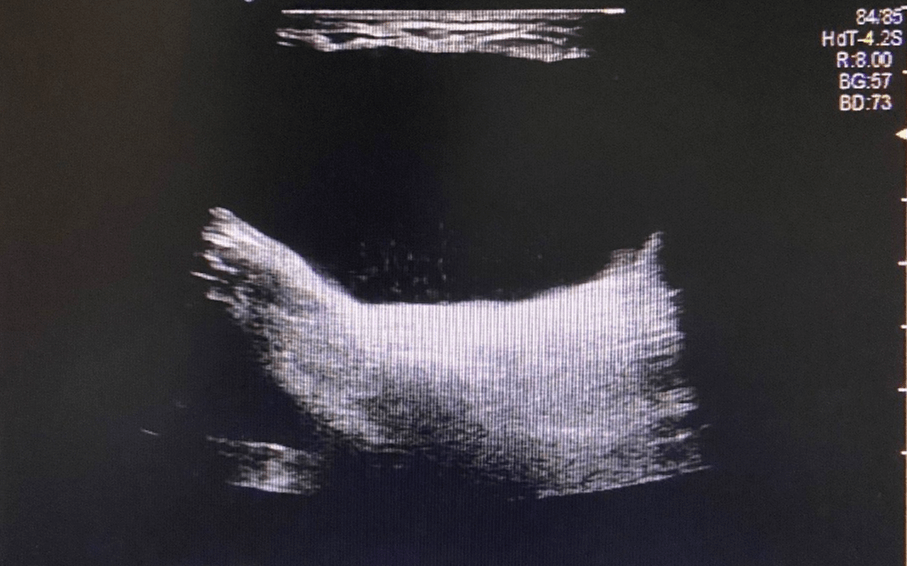 超声提示 左侧腹股沟无回声区,子宫圆韧带囊肿? 术后证实为