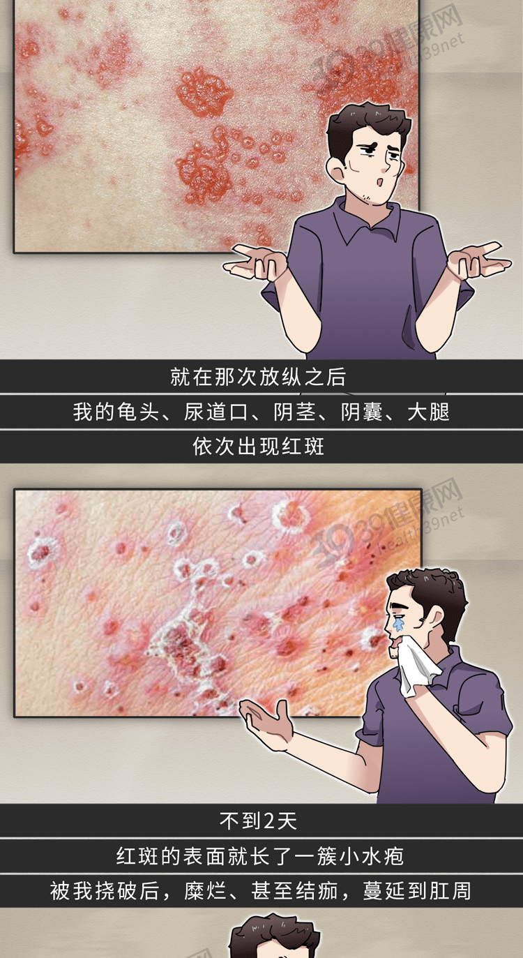 生殖器疱疹研究进展[j].中国艾滋