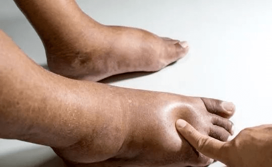 脚会变得麻木,肿胀,这可能是由于下肢的血管变窄堵塞的原因