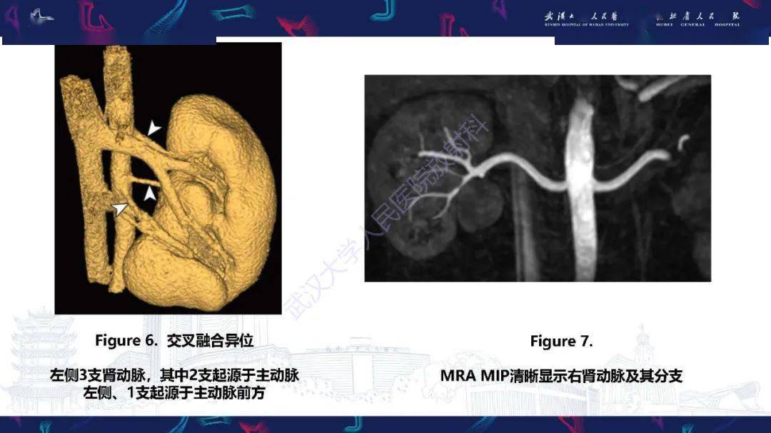 肾动脉:解剖,病理及血管内治疗