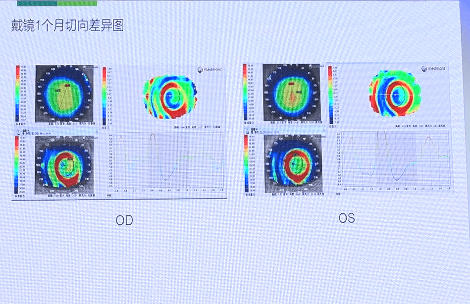 天津市眼科医院视光中心张姝贤主任myok角膜塑形镜的验配与案例