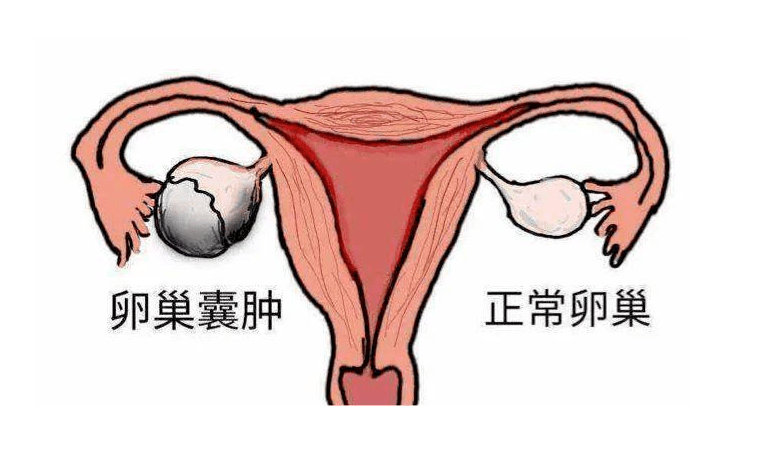 襄阳15岁女孩腹痛难忍,检查发现卵巢扭转900°!