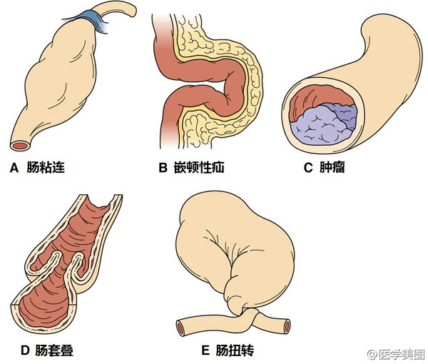 "肠梗阻"顾名思义就是肠内容物在肠道内发生"拥堵".