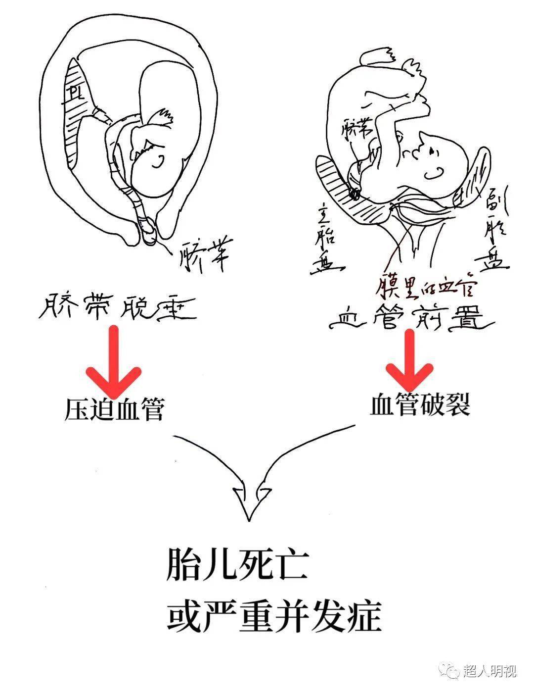 再谈血管前置和脐带脱垂