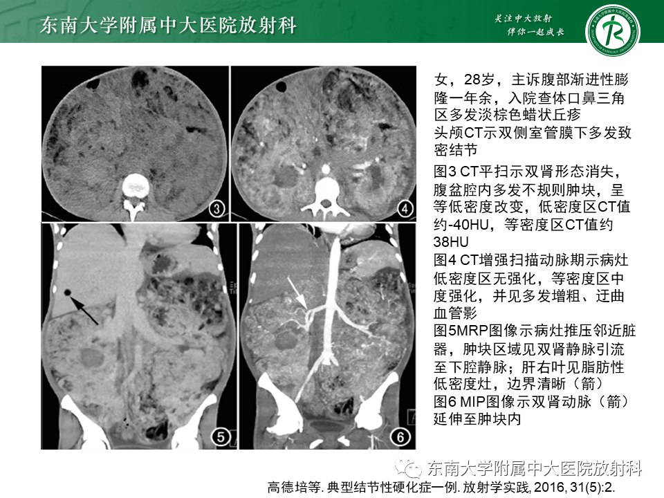 多系统疾病 | 结节性硬化症(tsc)