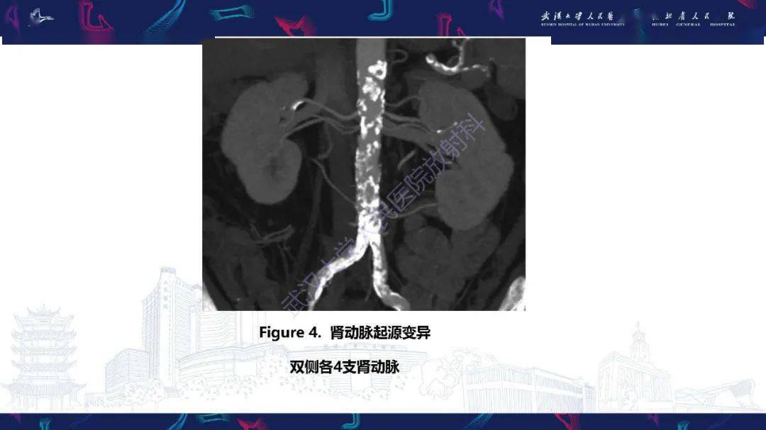 肾动脉解剖病理及血管内治疗