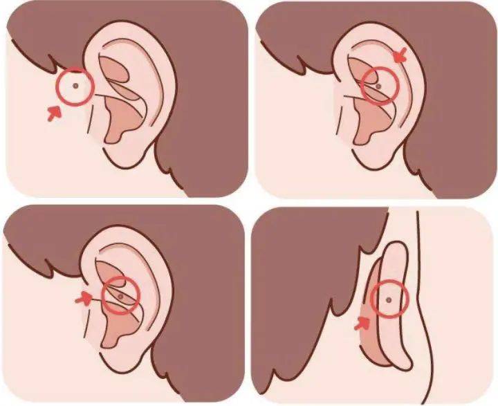 耳前瘘管多发生于耳部的周围,最常见的位置是位于耳廓的前方皮肤