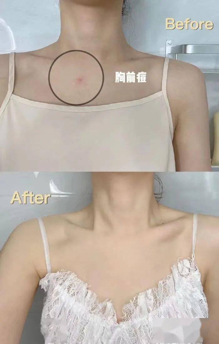 哪怕 戴几 十块项链,擦掉了胸口长的痘印子,立即变白富美!
