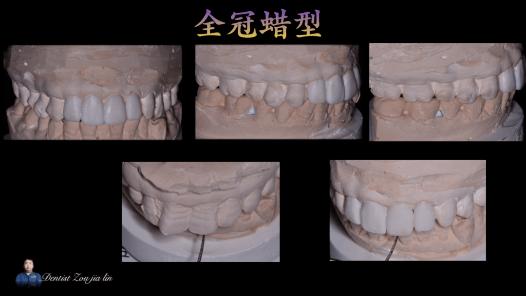 瑞尔病例报告第35期牙齿前突表面有条纹但不想正畸怎么办