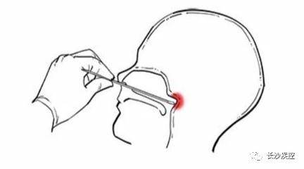 3.低风险地区开展核酸检测时,多采取采集口咽拭子的方式.