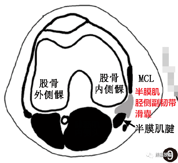 膝关节滑囊(分组,示意图)_解剖