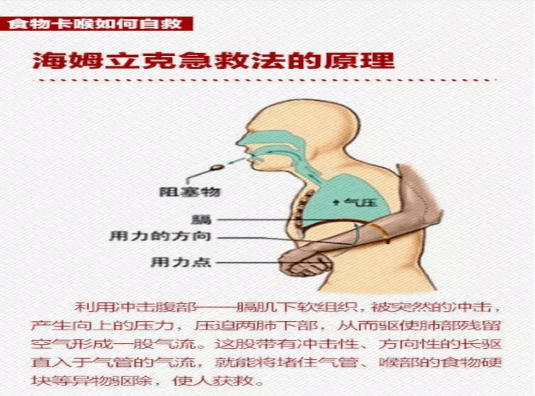 学会海姆立克法很有必要