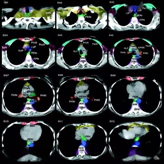 肿瘤医生必看:全身各区域淋巴结 ct 图谱