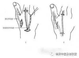 手部伸肌腱损伤:手指的伸展系统是肌腱与筋膜,腱膜,韧带的综合体,其