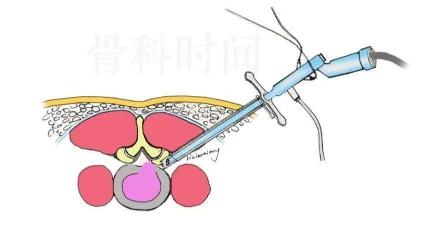 脊柱微创——椎间孔镜治疗腰椎间盘突出症