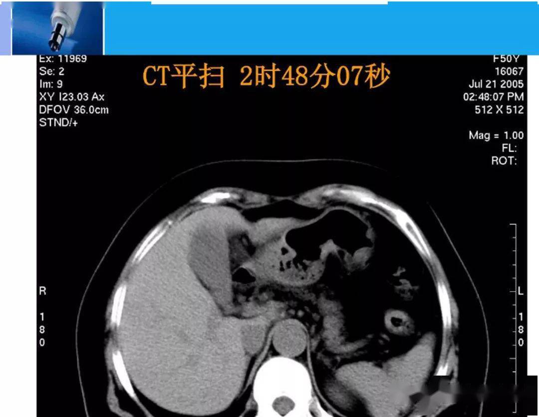 精华全篇肝脏的ct影像诊断