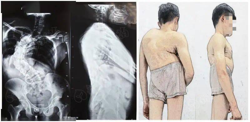 因为这个疾病蒙上了一层阴影 直到2018年 看到同是脊柱侧弯的表哥