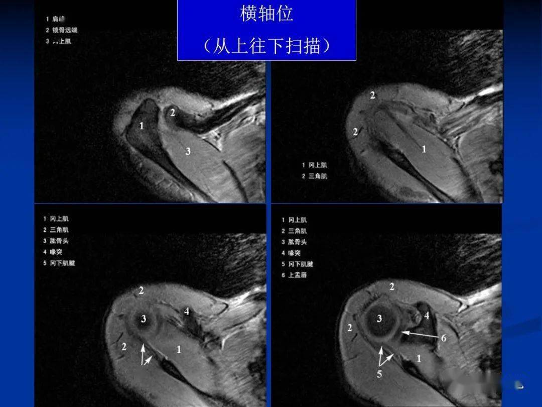 四个滑囊:肩峰下滑囊,三角肌下滑囊,喙突下滑囊,肩胛下滑囊.