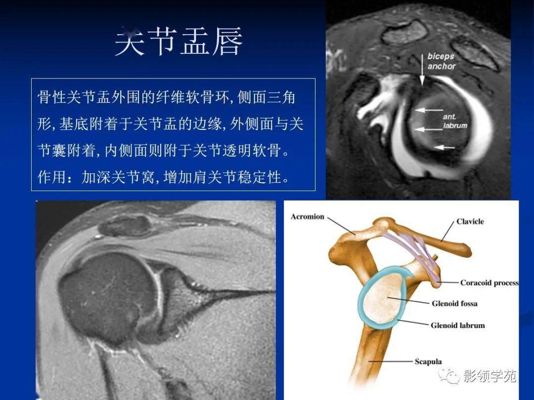 四个滑囊:肩峰下滑囊,三角肌下滑囊,喙突下滑囊,肩胛下滑囊.