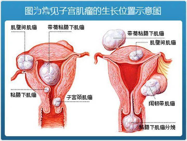 子宫肌瘤会造成不孕吗?可不可以生孩子?
