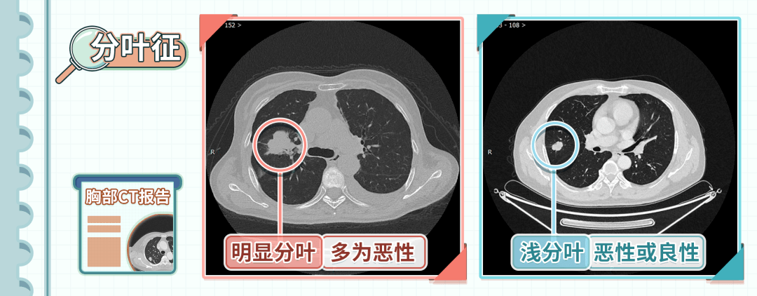 一看大小,二看形态,两招判断"肺结节"的良恶性!