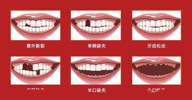 半口,全口缺牙市民;牙齿不齐,牙齿外凸,畸形牙,残缺破损,牙齿稀疏市民