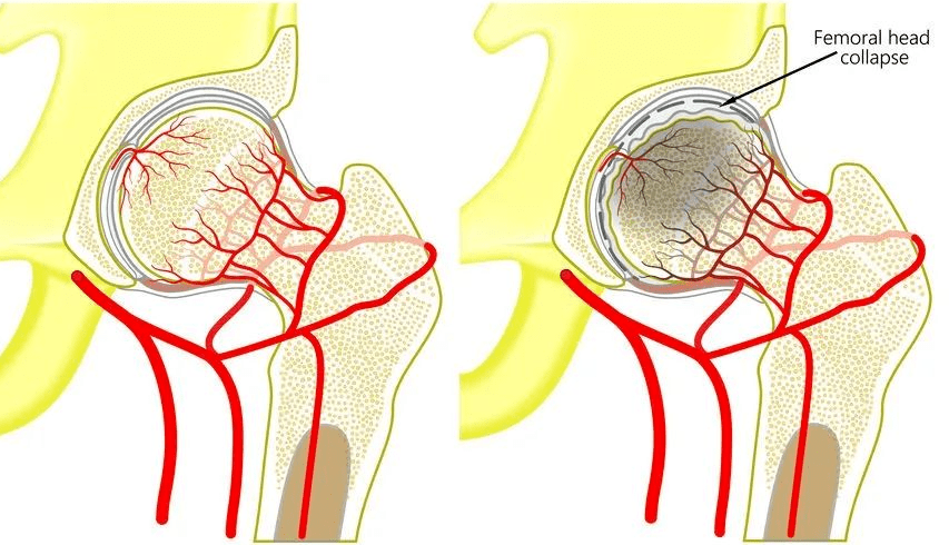 会导致股骨头坏死