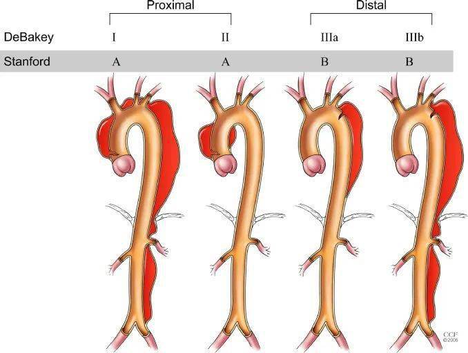 收藏级主动脉夹层分型精美插图版