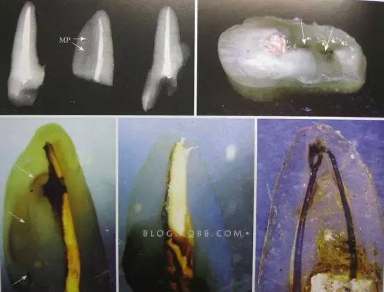 专家经过离体牙根尖切片研究发现根尖狭窄部远比想象的要大,如果根管