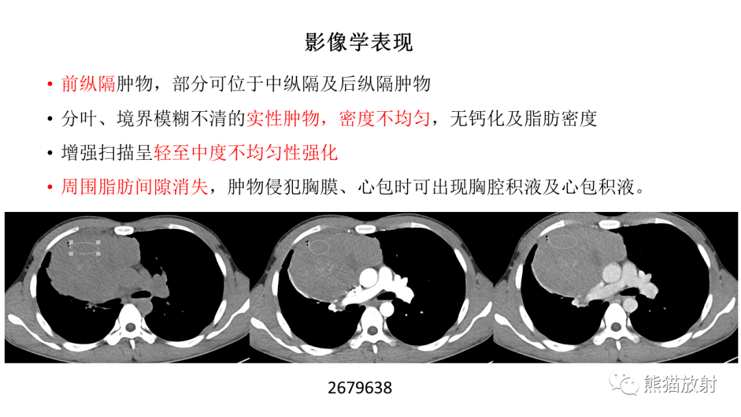 【省立影像读片】前纵隔肿瘤 21.09