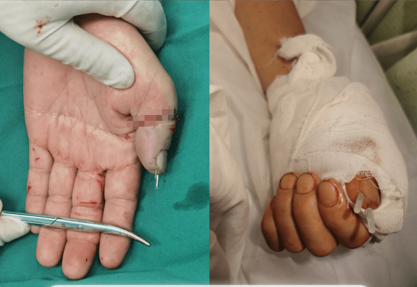 怀化58岁工人手指卷入机器,左手拇指被割断,骨科医生让断指"死而复生"