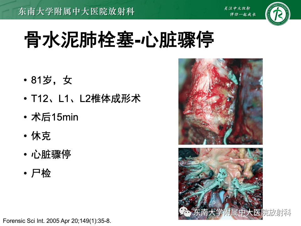 骨水泥肺栓塞影像表现