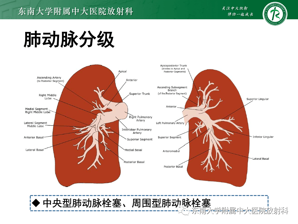 骨水泥肺栓塞影像表现