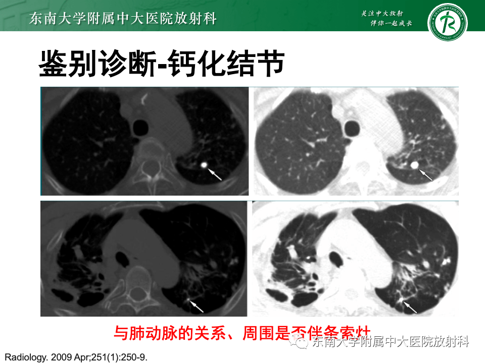 骨水泥肺栓塞影像表现