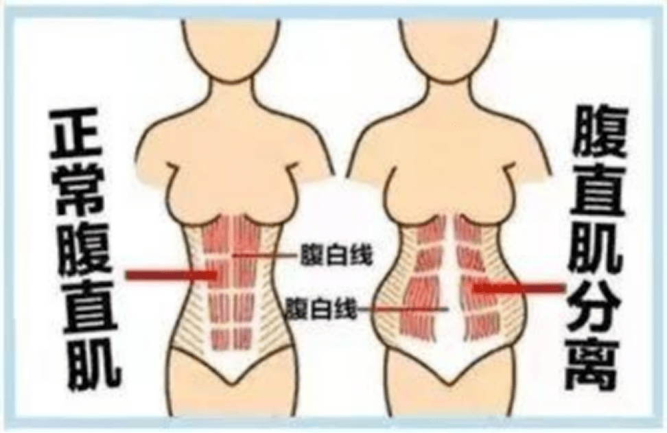快速减肥后腰腹部松垂,产后皮肤松弛,妊娠纹难以祛除等原因导致的腹