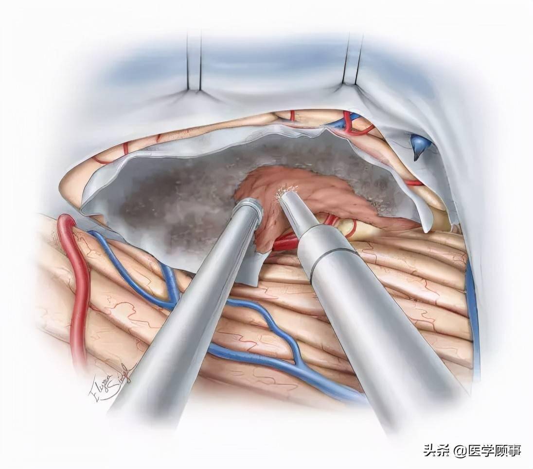 后颅凹天幕脑膜瘤手术策略与技巧